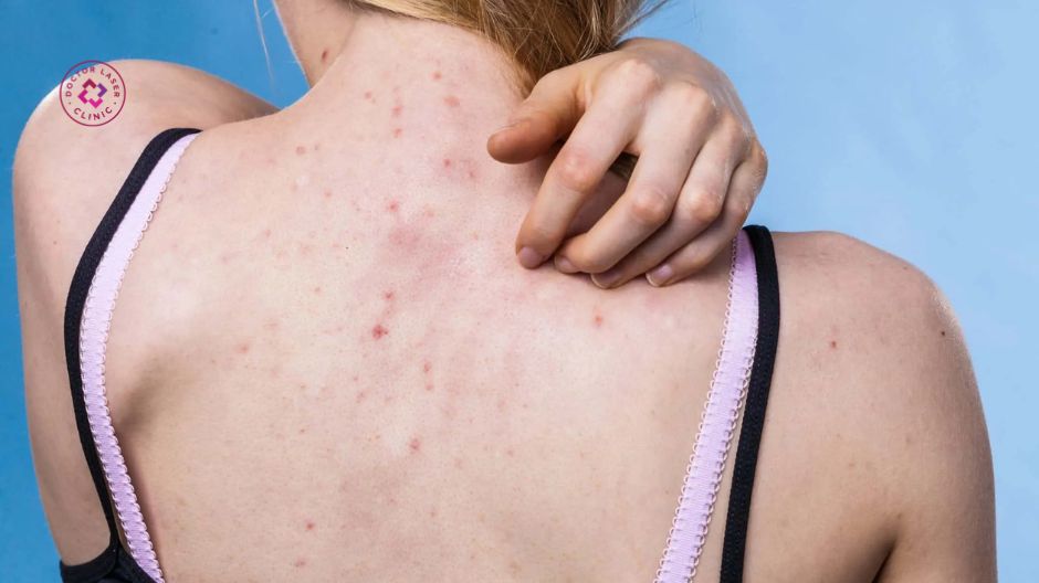 tiền sử gia đình mụn lưng