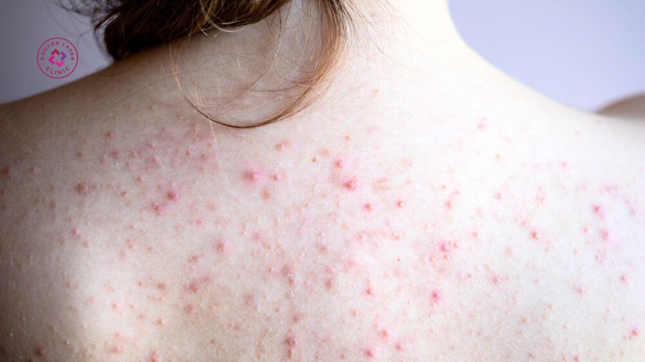 tình trạng mụn lưng thường gặp