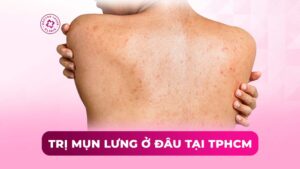 trị mụn lưng ở đâu tại tphcm trị mụn lưng ở đâu tại tphcm