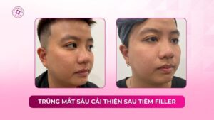 trũng mắt sâu cải thiện sau tiêm filler tại doctor laser trũng mắt sâu cải thiện sau tiêm filler tại doctor laser