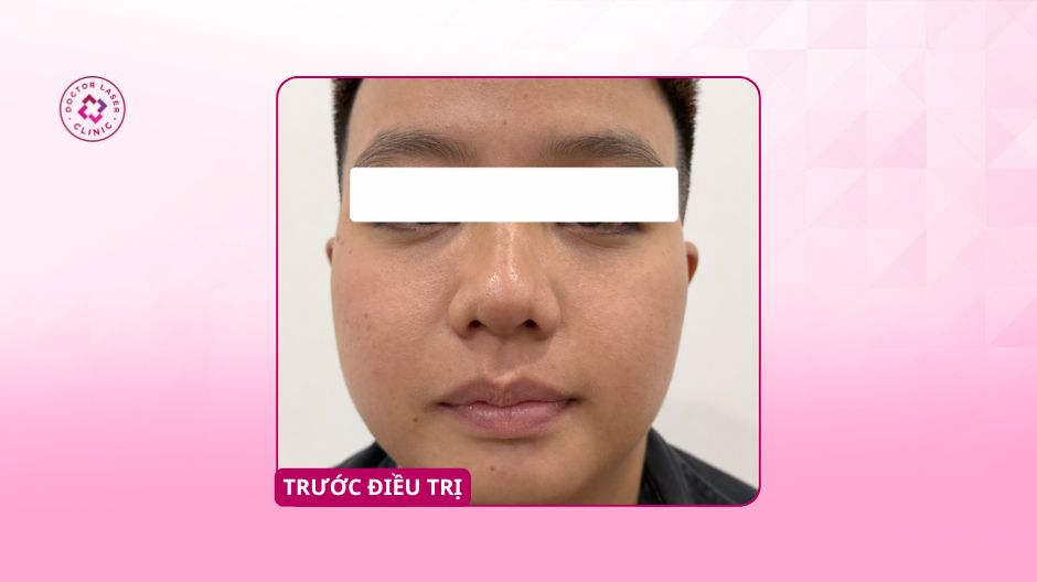 trũng mắt sâu trước điều trị filler tại doctor laser