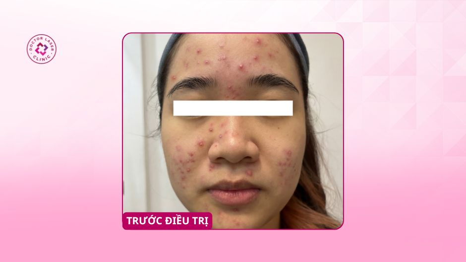 trước điều trị mụn viêm nặng