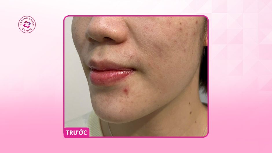 trước điều trị sắc tố da