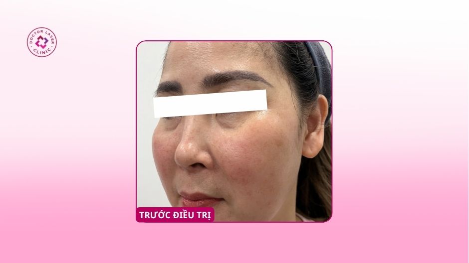 trước điều trị trũng hốc mắt sâu