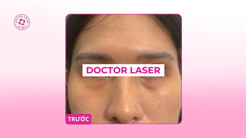 trước điều trị trũng mắt quầng thâm kéo dài