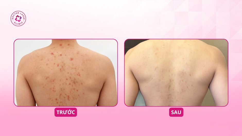 trước sau điều trị mụn lưng hiệu quả