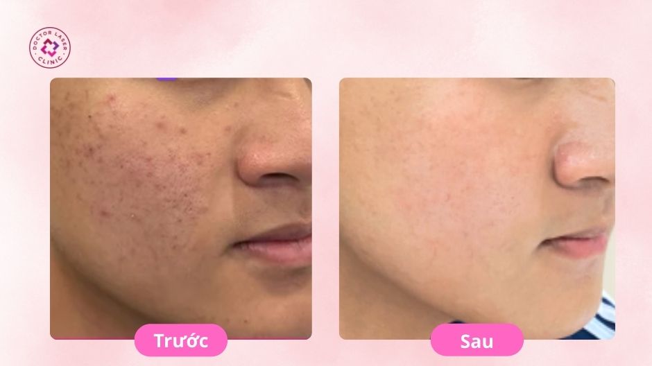 trước sau điều trị mụn thâm
