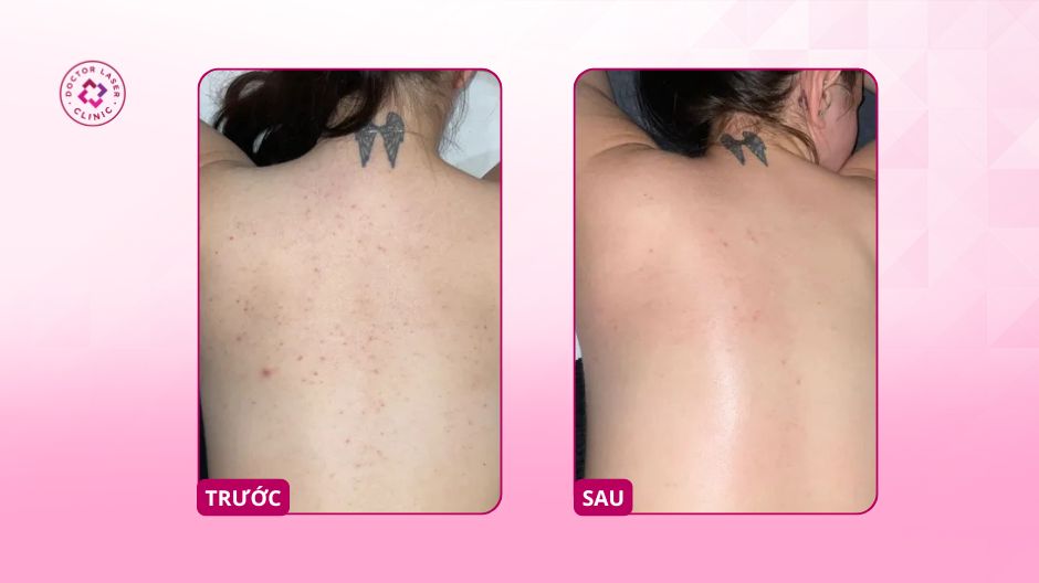 trước sau điều trị mụn trứng cá ở lưng