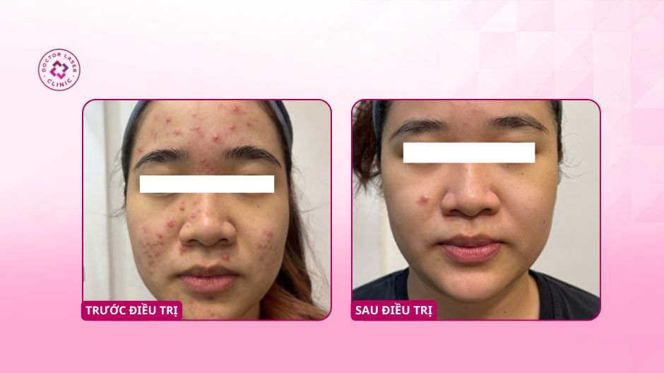 trước sau điều trị mụn viêm