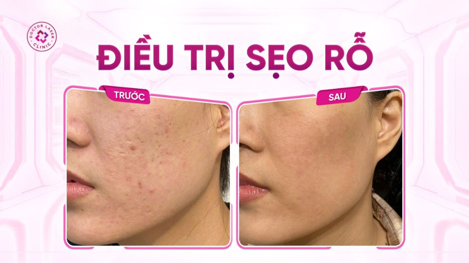 trước sau điều trị sẹo rỗ laser co2 fractional