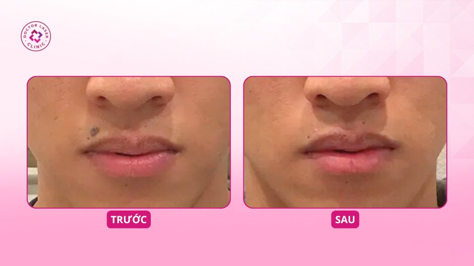 trước sau tẩy nốt ruồi laser co2