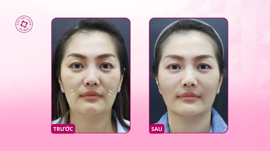 trước sau tiêm botox rãnh cười