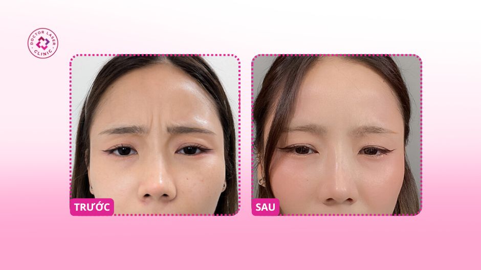 trước sau tiêm botox xoá nhăn cau mày