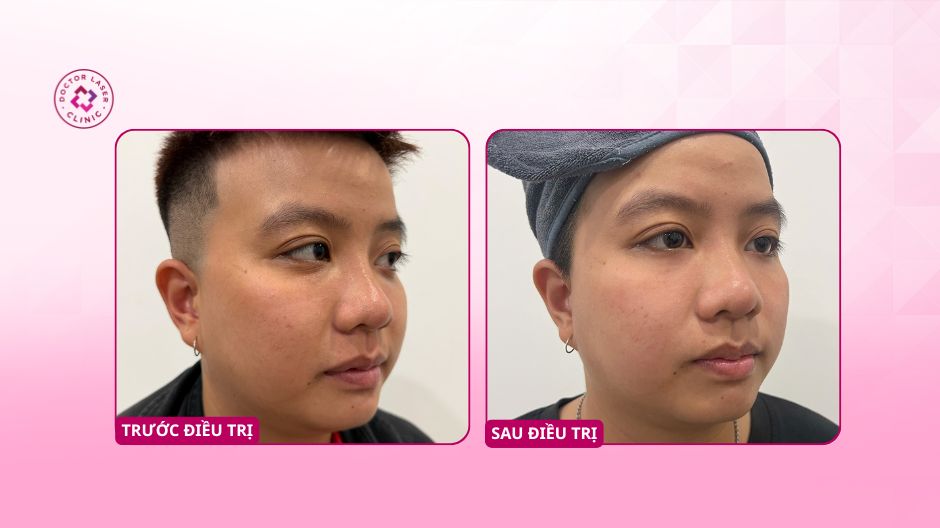 trước sau tiêm filler trũng mắt doctor laser