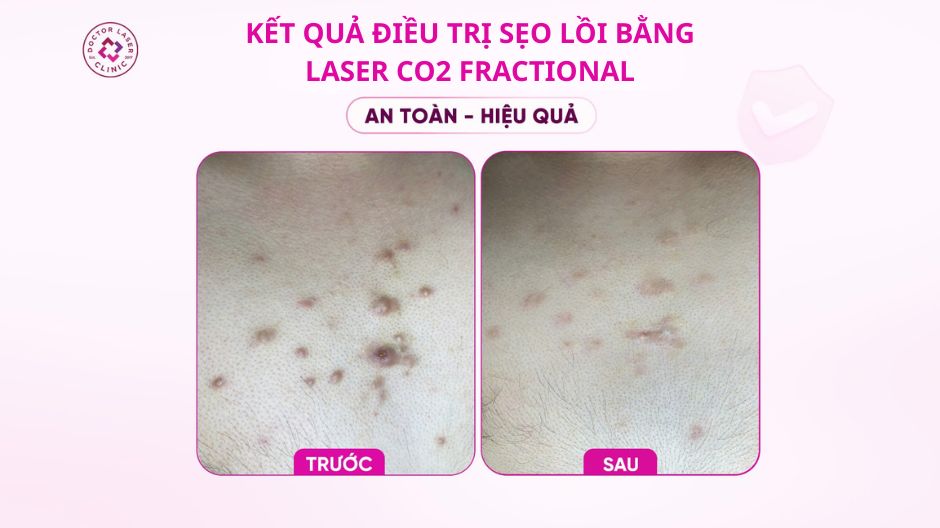 trước sau trị sẹo lồi bằng laser co2 fractional