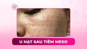 u hạt sau tiêm meso