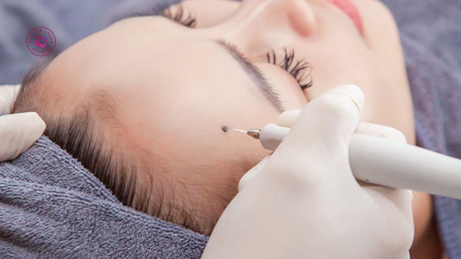 ưu điểm laser co2 tẩy nốt ruồi