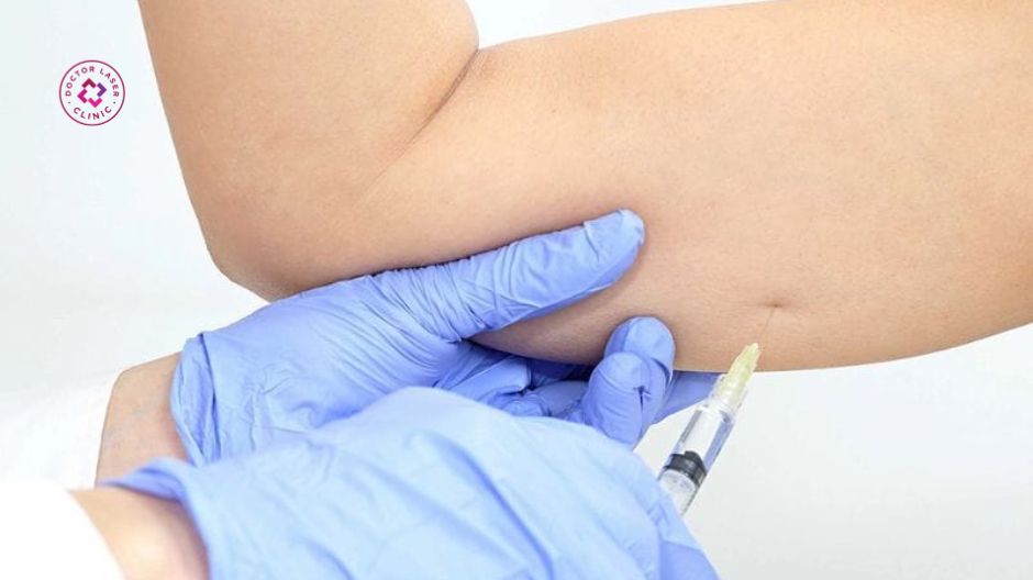 ưu điểm tiêm botox bắp tay