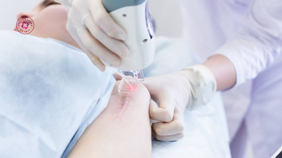 ưu điểm trị sẹo lồi bằng laser co2 fractional