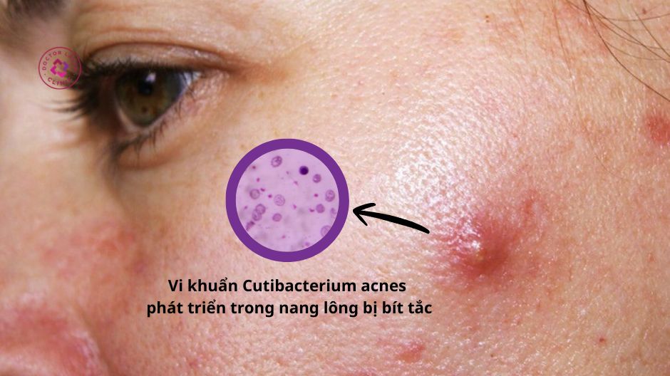 vi khuẩn Cutibacterium acnes gây mụn bọc
