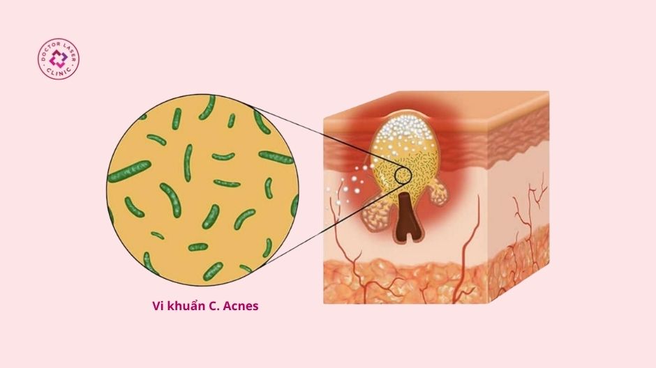 vi khuẩn c. acnes gây viêm mụn bọc ở lưng