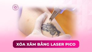 xóa xăm bằng laser pico