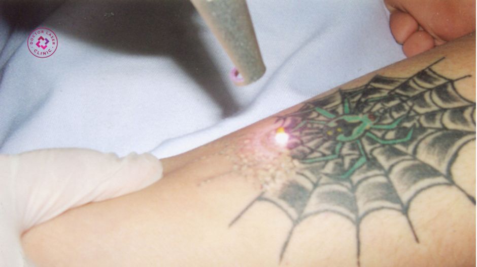 xóa xăm pico laser cần nhiều buổi