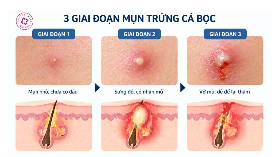 3 giai đoạn mụn trứng cá bọc