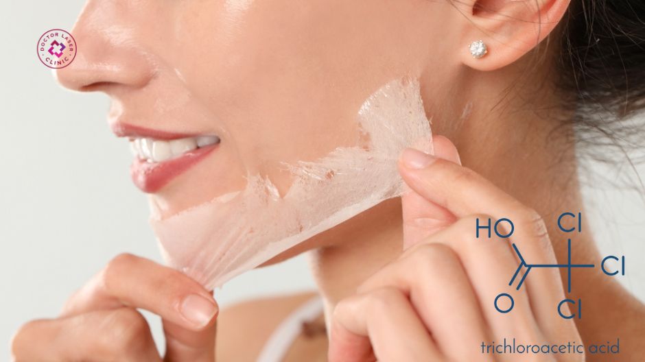 acid trichloroacetic tca trong peel da trị nám