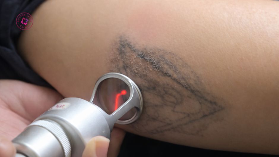 bác sĩ đang xoá xăm bằng laser