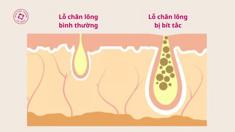 bít tắc lỗ chân lông ở mũi gây mụn bọc