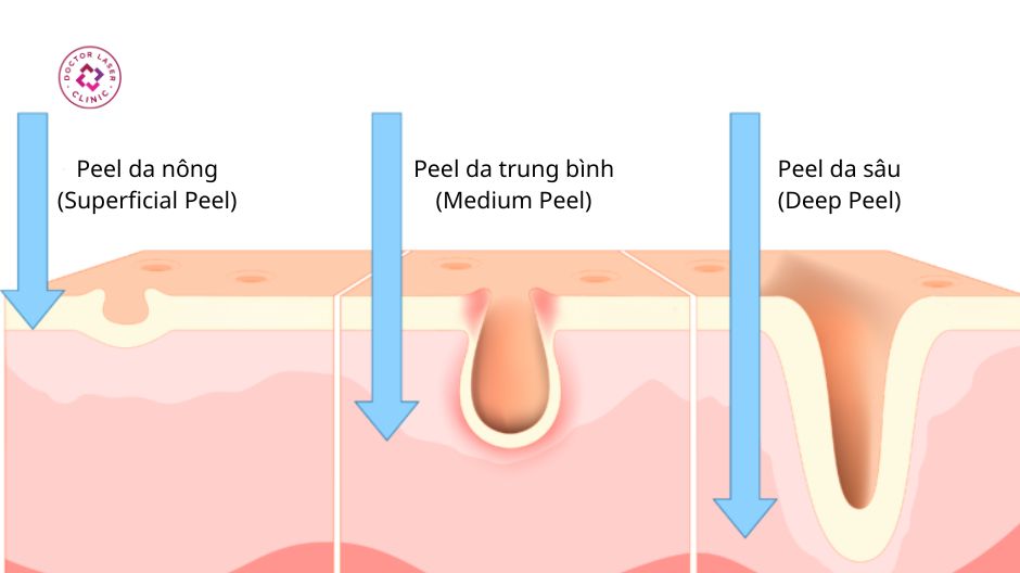 các cấp độ peel da trị mụn
