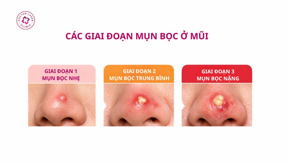 các giai đoạn mụn bọc ở mũi từ nhẹ đến nặng