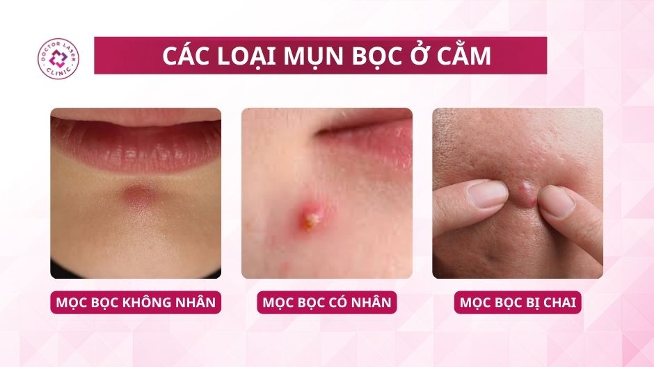 các loại mụn bọc ở cằm