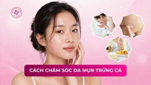 cách chăm sóc da mụn trứng cá