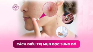 cách điều trị mụn bọc sưng đỏ