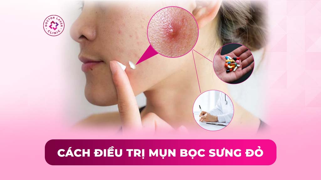 Mụn bọc sưng đỏ: Nguyên nhân và cách điều trị theo từng mức độ