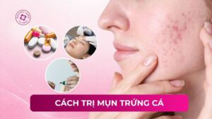 cách trị mụn trứng cá