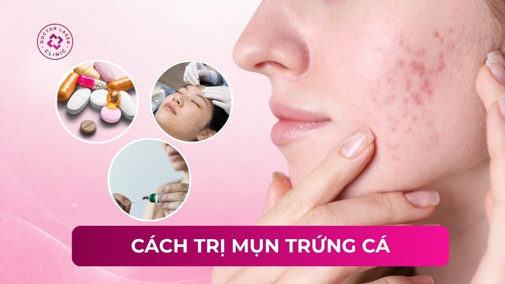 Cách trị mụn trứng cá theo từng mức độ cụ thể và yếu tố ảnh hưởng