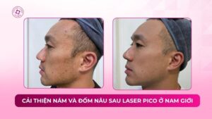 cải thiện nám và đốm nâu sau laser pico ở nam giới