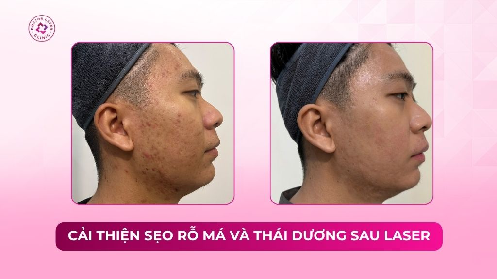 cải thiện sẹo rỗ má và thái dương sau laser