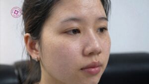 chỉ tiêm Mesotherapy đã đủ để cải thiện da chưa, hay cần kết hợp thêm liệu trình khác