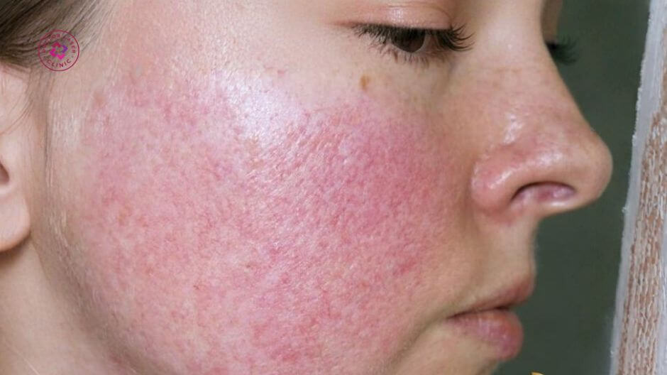 da ửng đỏ và châm chích nhẹ sau peel
