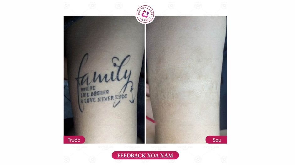 đánh giá khách hàng xoá xăm trước sau