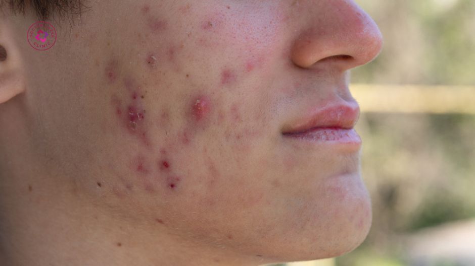 dấu hiệu nên dùng thuốc trị mụn bọc mụn viêm