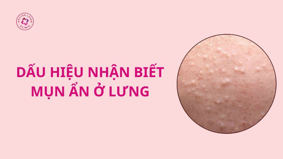 dấu hiệu nhận biết mụn ẩn ở lưng