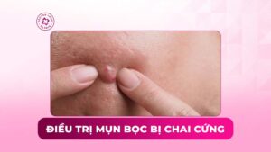 điều trị mụn bọc bị chai cứng