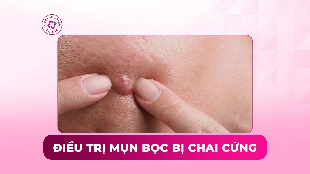 Điều trị mụn bọc bị chai cứng theo quy trình chuẩn y khoa
