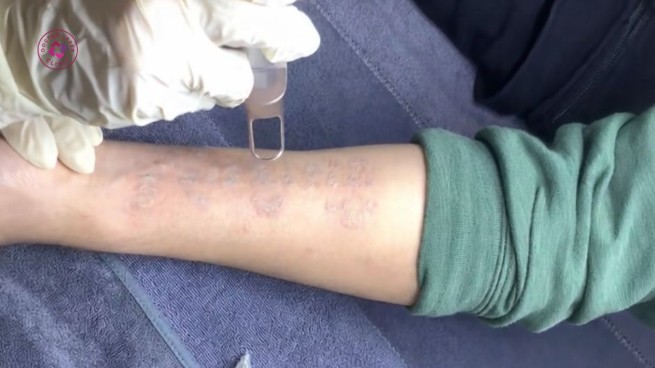 điều trị xoá hình xăm cánh tay bằng laser pico