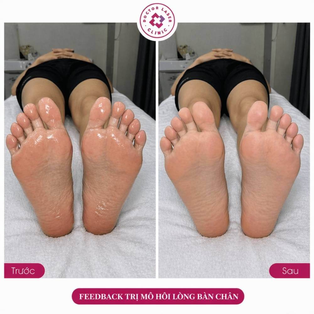 feedback trị mồ hôi lòng bàn chân